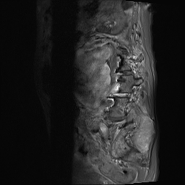 File:Aortic aneurysm with spinal destruction (Radiopaedia 42301-45409 Sagittal T1 fat sat 34).jpg