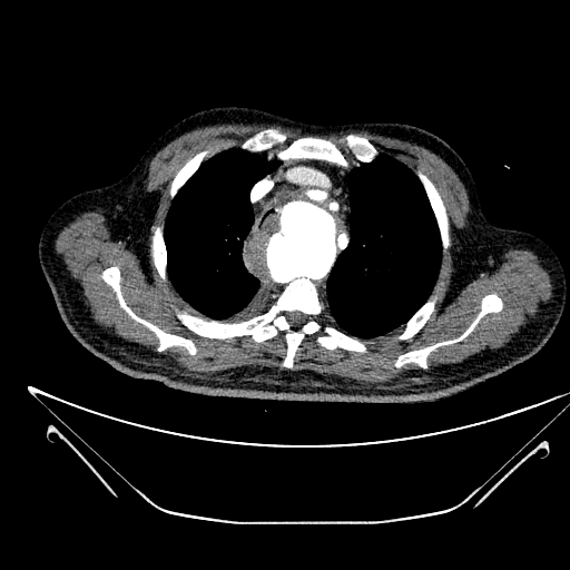 Aortic arch aneurysm (Radiopaedia 84109-99365 B 165).jpg
