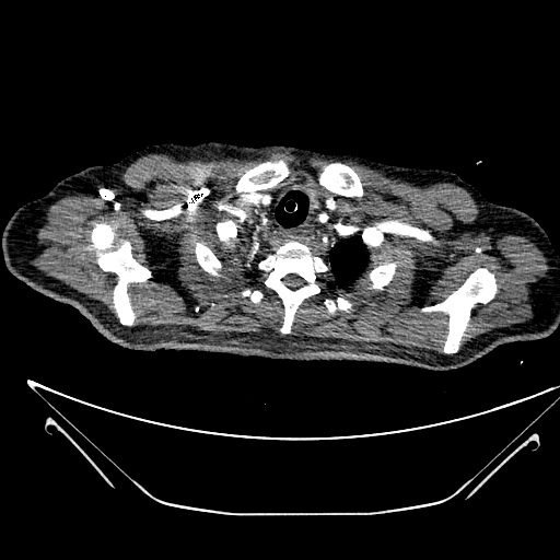 Aortic arch aneurysm (Radiopaedia 84109-99365 B 71).jpg
