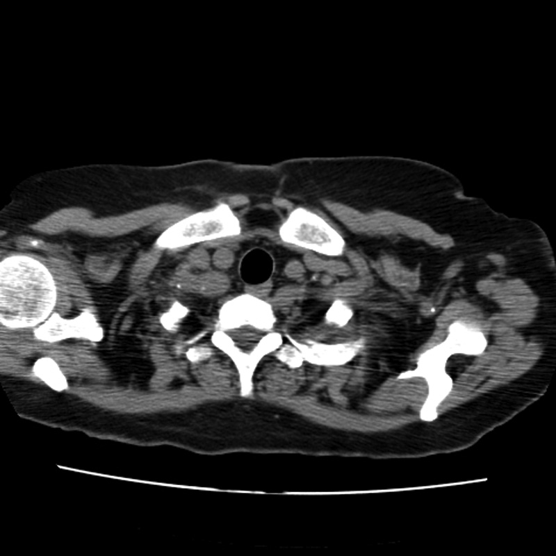 Aortic arch pseudoaneurysm (Radiopaedia 8534-9368 Axial non-contrast 2).jpg