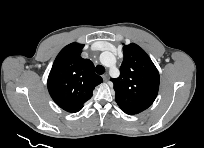 File:Aortic coarctation with aneurysm (Radiopaedia 74818-85828 A 154).jpg