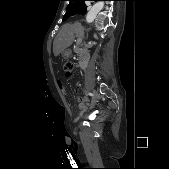 Aortic dissection (CTPA) (Radiopaedia 75506-86750 G 43).jpg