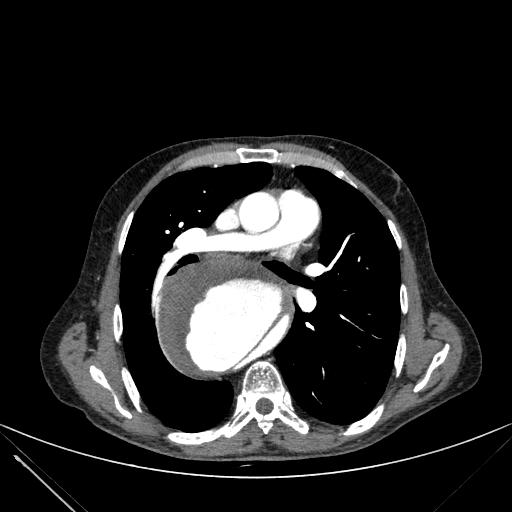 Aortic dissection (Radiopaedia 27466-27665 C+ arterial phase 119).jpg