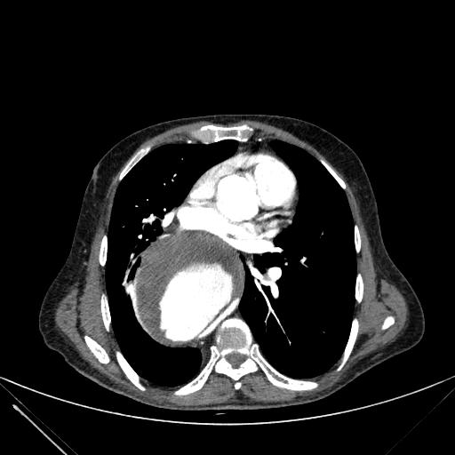 Aortic dissection (Radiopaedia 27466-27665 C+ arterial phase 141).jpg