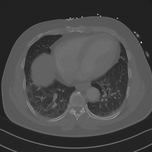 File:Aortic dissection (Radiopaedia 50763-56234 Axial bone window 72).png