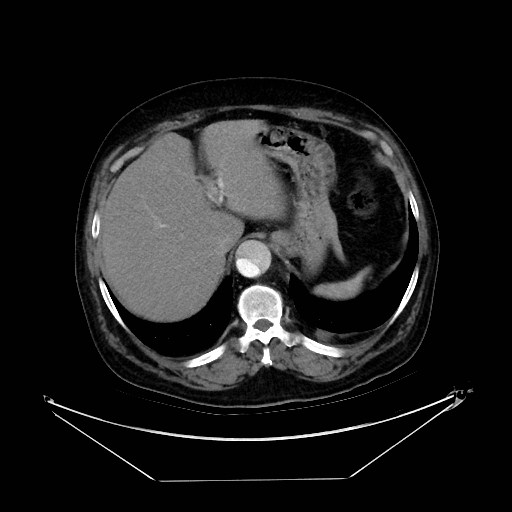 Aortic dissection (Radiopaedia 62562-71000 A 43).jpg