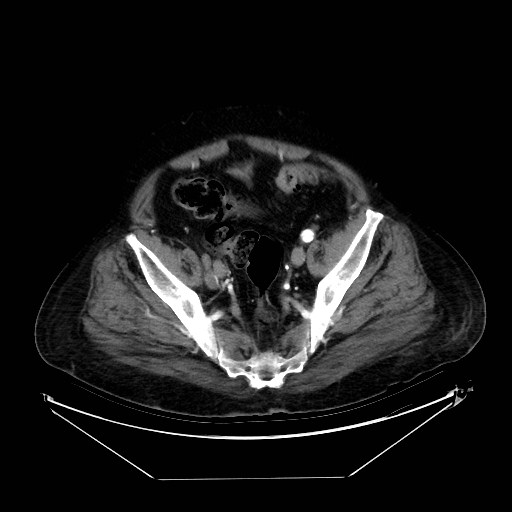 Aortic dissection (Radiopaedia 62562-71000 A 97).jpg