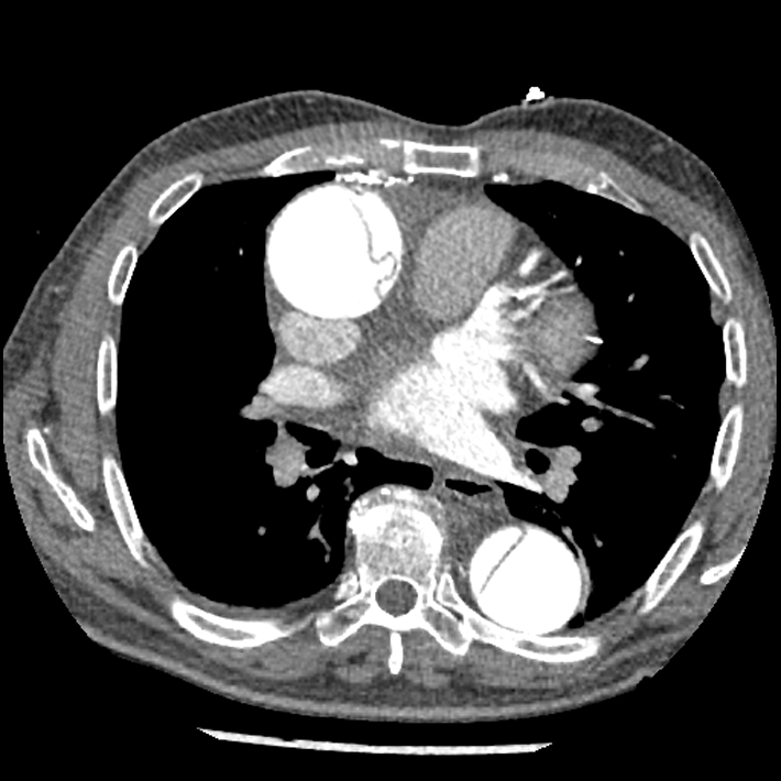 Aortic dissection - DeBakey Type I-Stanford A (Radiopaedia 79863-93115 A 19).jpg