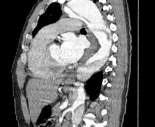 Aortic dissection - Stanford A -DeBakey I (Radiopaedia 28339-28587 C 45).jpg