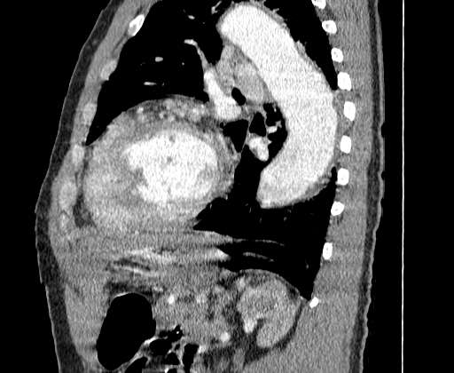 File:Aortic dissection - Stanford A -DeBakey I (Radiopaedia 28339-28587 C 62).jpg