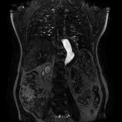 File:Aortic dissection - Stanford A - DeBakey I (Radiopaedia 23469-23551 D 163).jpg