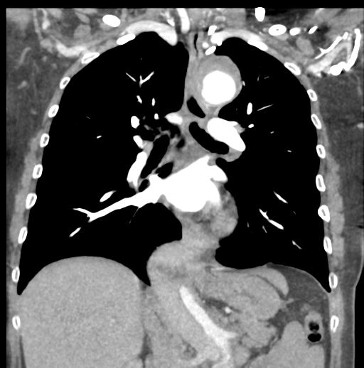 Aortic dissection - Stanford type B (Radiopaedia 50171-55512 B 46).png