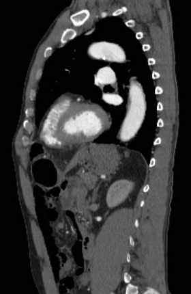 File:Aortic dissection - Stanford type B (Radiopaedia 73648-84437 C 56).jpg