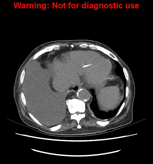 Aortic graft infection (Radiopaedia 44979-48907 Axial non-contrast 17).jpg