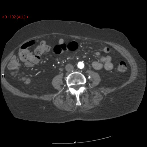 Aortic intramural hematoma (Radiopaedia 27746-28001 A 132).jpg