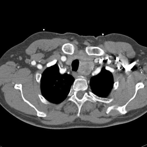 Aortic intramural hematoma (Radiopaedia 31139-31838 B 13).jpg