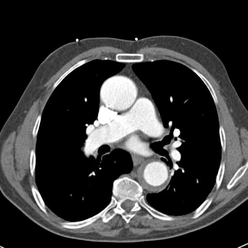 Aortic intramural hematoma (Radiopaedia 31139-31838 B 43).jpg