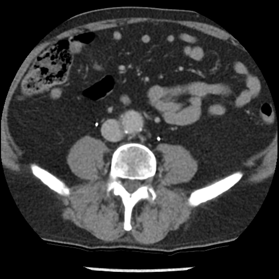 Aortic intramural hematoma (type B) (Radiopaedia 79323-92387 Axial C+ delayed 82).jpg
