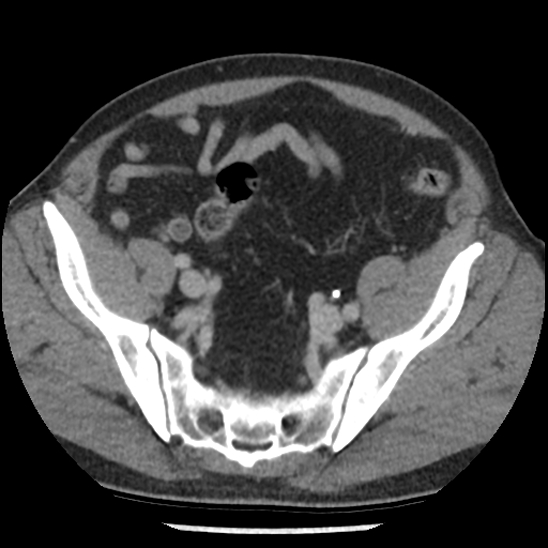 Aortic intramural hematoma (type B) (Radiopaedia 79323-92387 Axial C+ delayed 97).jpg