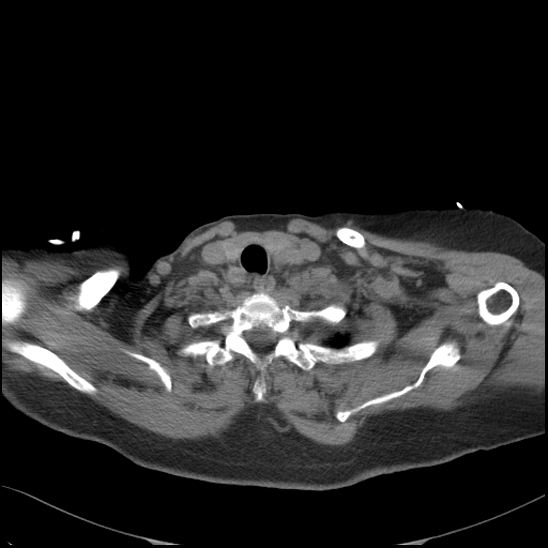 Aortic intramural hematoma with dissection and intramural blood pool (Radiopaedia 77373-89491 Axial non-contrast 12).jpg