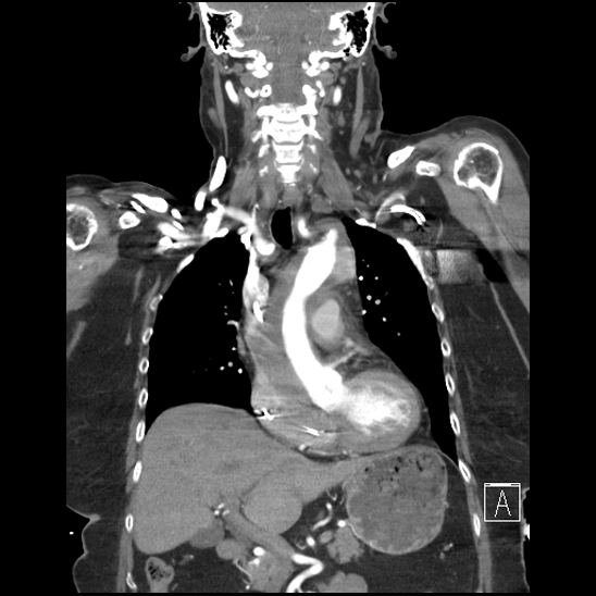 Aortic intramural hematoma with dissection and intramural blood pool (Radiopaedia 77373-89491 C 25).jpg