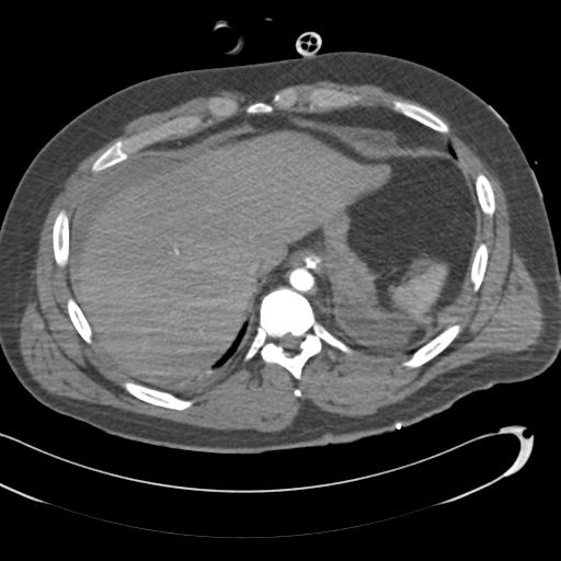 Aortic transection, diaphragmatic rupture and hemoperitoneum in a complex multitrauma patient (Radiopaedia 31701-32622 A 73).jpg