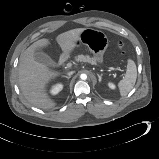 Aortic transection, diaphragmatic rupture and hemoperitoneum in a complex multitrauma patient (Radiopaedia 31701-32622 A 90).jpg