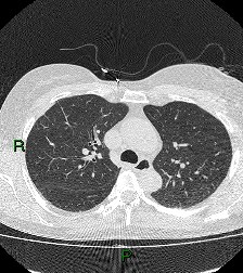 File:Aortic valve endocarditis (Radiopaedia 87209-103485 Axial lung window 36).jpg