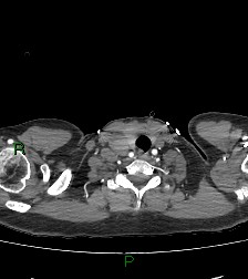 Aortic valve endocarditis (Radiopaedia 87209-103485 C 2).jpg
