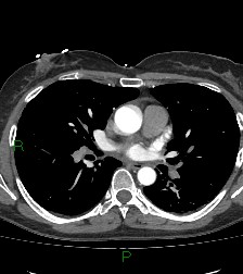 Aortic valve endocarditis (Radiopaedia 87209-103485 C 47).jpg