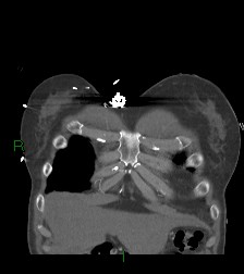 Aortic valve endocarditis (Radiopaedia 87209-103485 D 63).jpg