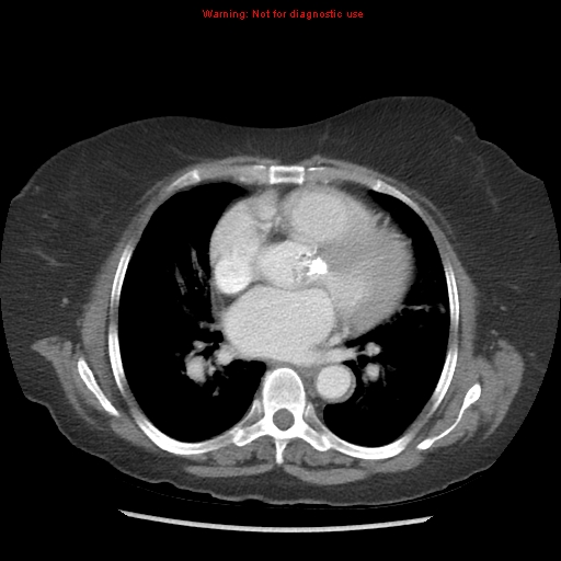 File:Aortic valve stenosis (Radiopaedia 14480-14423 C 6).jpg