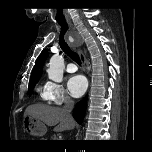 File:Aorto-coronary bypass graft aneurysms (Radiopaedia 40562-43157 C 16).png