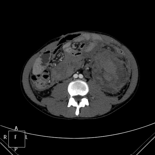 File:Aorto-left renal vein fistula (Radiopaedia 45534-49628 A 39).jpg
