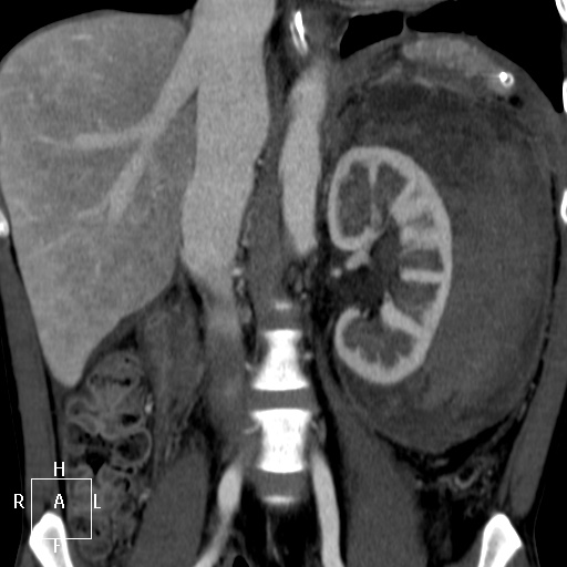 File:Aorto-left renal vein fistula (Radiopaedia 45534-49628 B 37).jpg
