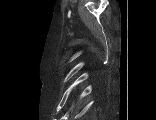 Aortoesophageal fistula with endovascular repair (Radiopaedia 73781-84592 Sagittal C+ CTPA 189).jpg