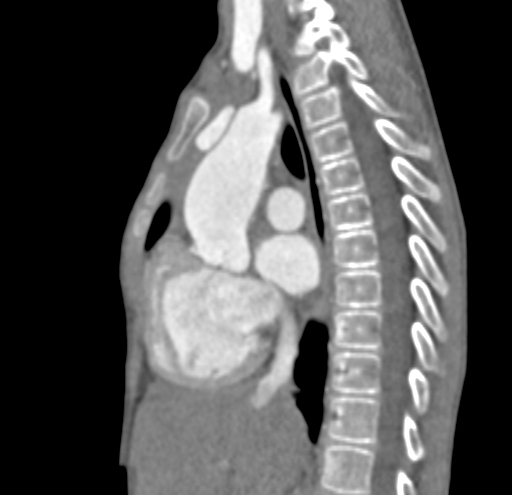 File:Aortopulmonary window, interrupted aortic arch and large PDA giving the descending aorta (Radiopaedia 35573-37074 C 14).jpg