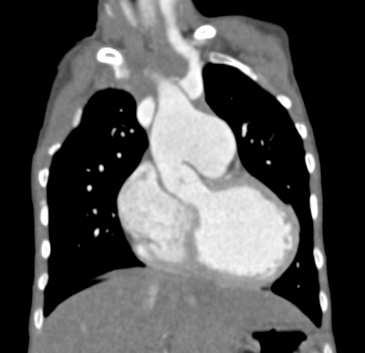 File:Aortopulmonary window, interrupted aortic arch and large PDA giving the descending aorta (Radiopaedia 35573-37074 D 22).jpg