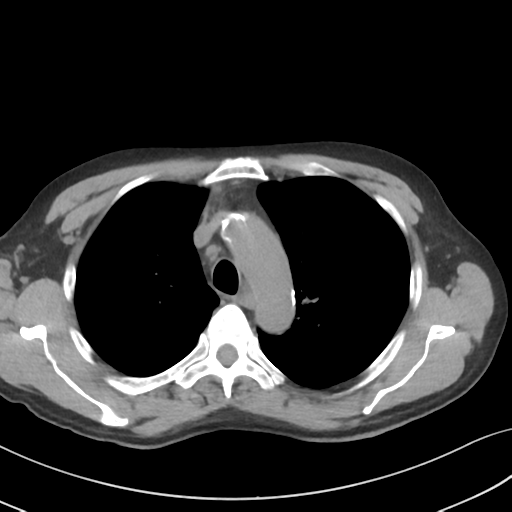 Apical pulmonary metastasis (Radiopaedia 46338-50754 B 20).png