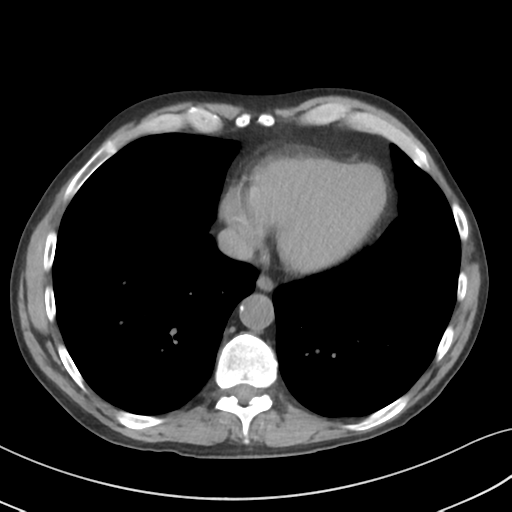 Apical pulmonary metastasis (Radiopaedia 46338-50754 B 47).png