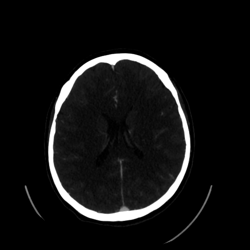 Aplasia of the internal carotid artery (Radiopaedia 61082-68960 A 43).jpg