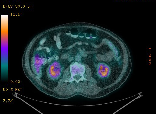 File:Appendiceal adenocarcinoma complicated by retroperitoneal abscess (Radiopaedia 58007-65041 Axial PET-CT 125).jpg