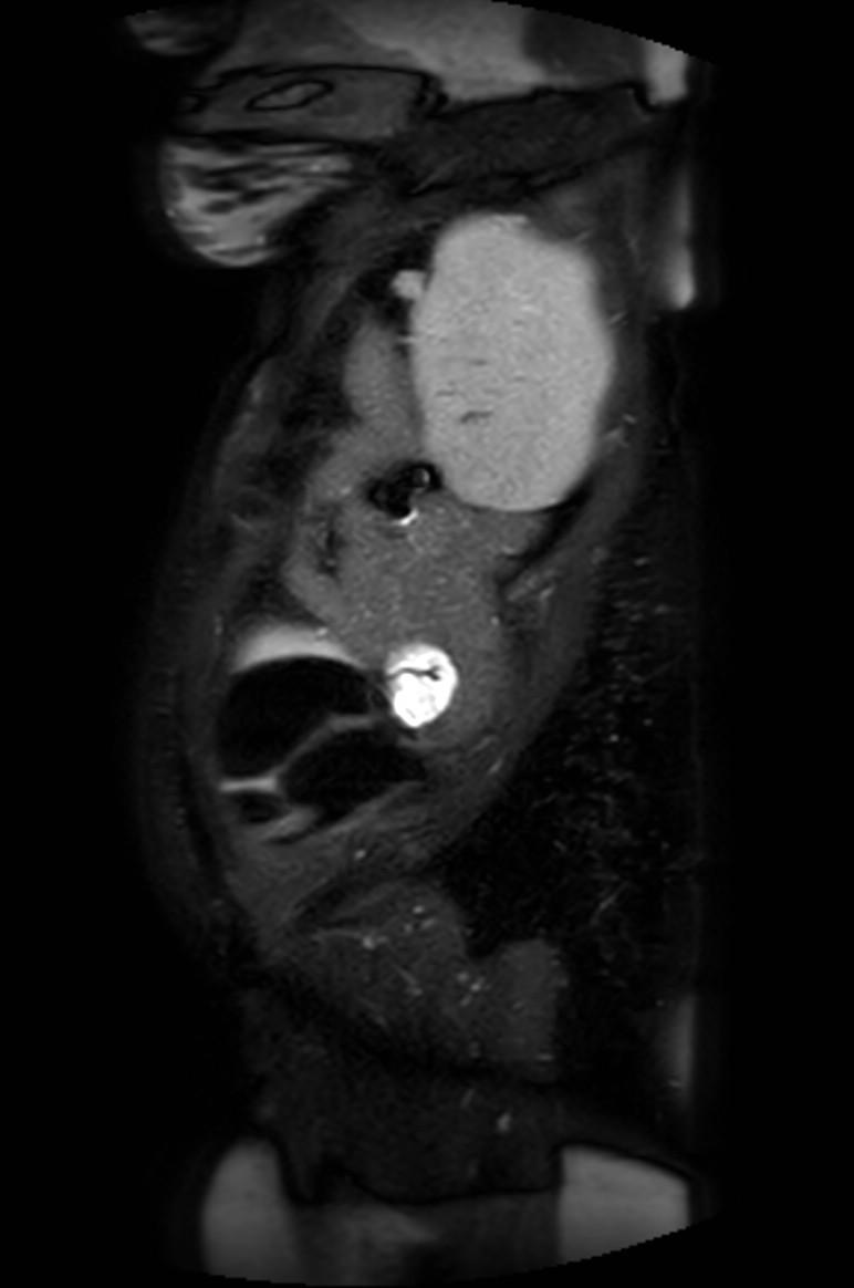 Appendicitis in gravida (MRI) (Radiopaedia 89433-106395 Sagittal T2 SPAIR 7).jpg