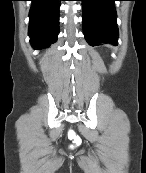 Appendicitis with cecal bar sign (Radiopaedia 31878-32830 A 50).jpg