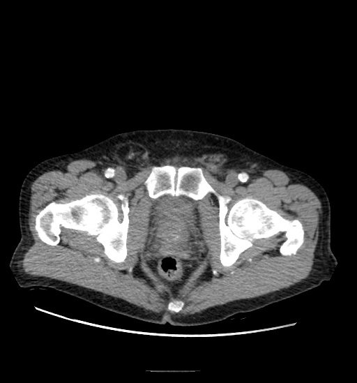 File:Appendicitis with localized perforation and abscess formation (Radiopaedia 49035-54130 A 84).jpg