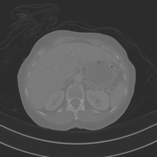 April fools' 2019- calcified peritoneal arachnoidosis (Radiopaedia 67273-76636 Axial bone window 3).png