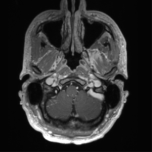 File:Arachnoid cyst with subdural hematoma (Radiopaedia 85892-101743 Axial T1 C+ 14).png