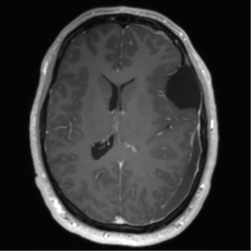 Arachnoid cyst with subdural hematoma (Radiopaedia 85892-101743 Axial T1 C+ 50).png