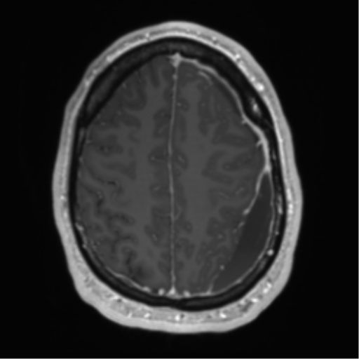 File:Arachnoid cyst with subdural hematoma (Radiopaedia 85892-101743 Axial T1 C+ 65).png