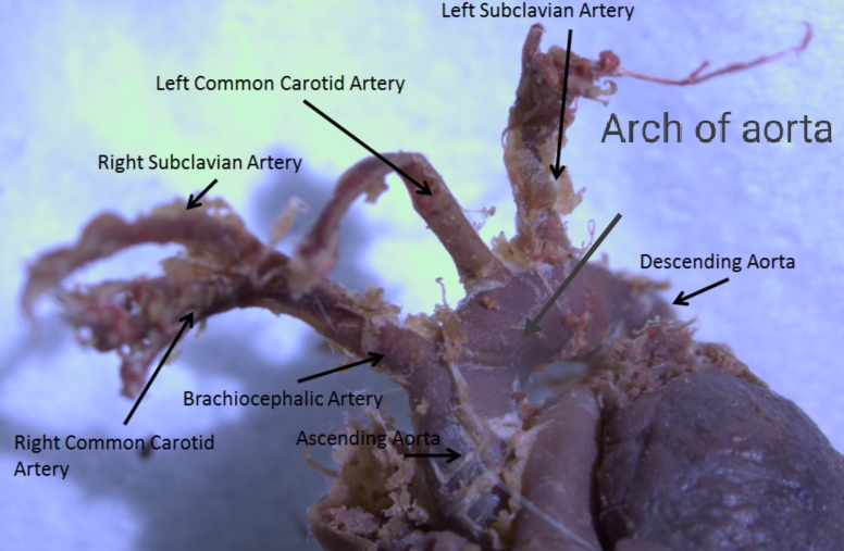 File:Arch of aorta and its branches (Radiopaedia 88471).jpg